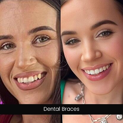 Before and after braces showing improved alignment and bite, resulting in a more aesthetic smile.